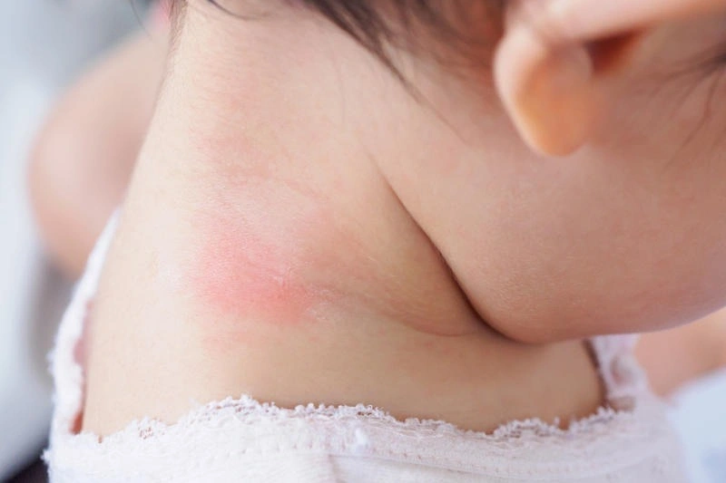 Trẻ bị hăm cổ