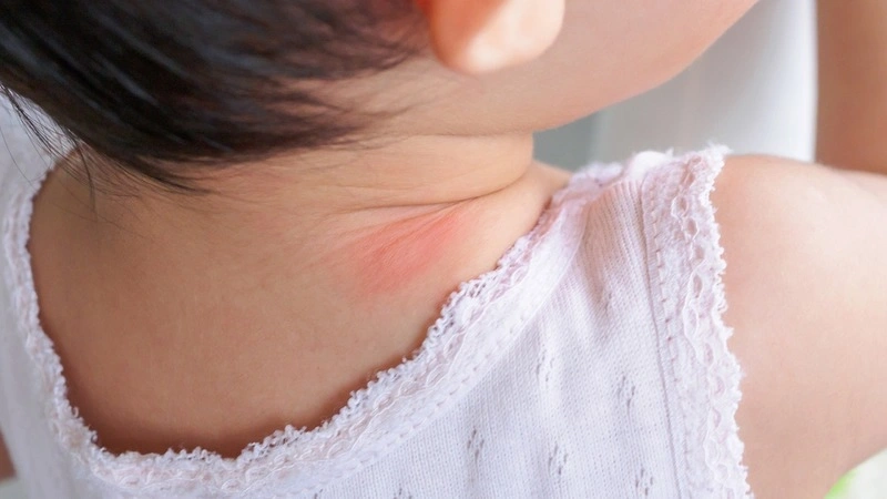 Bé bị hăm cổ do đâu