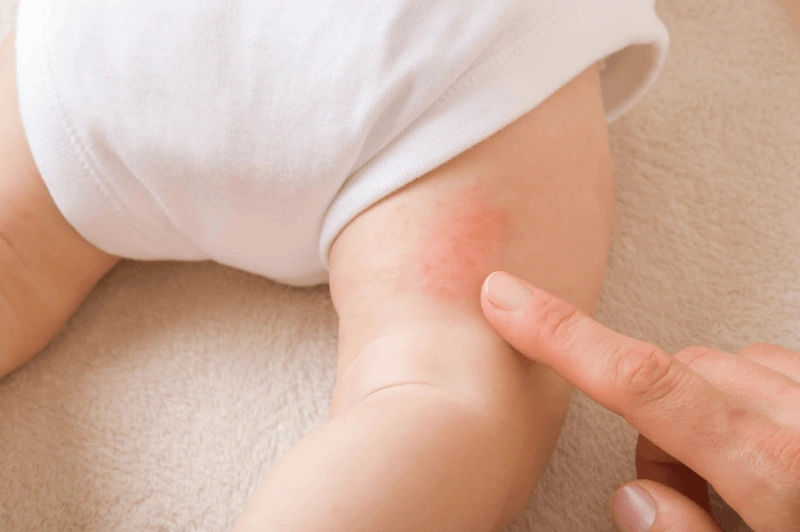 Dấu hiệu trẻ không hợp sữa công thức là hay dị ứng, kích ứng