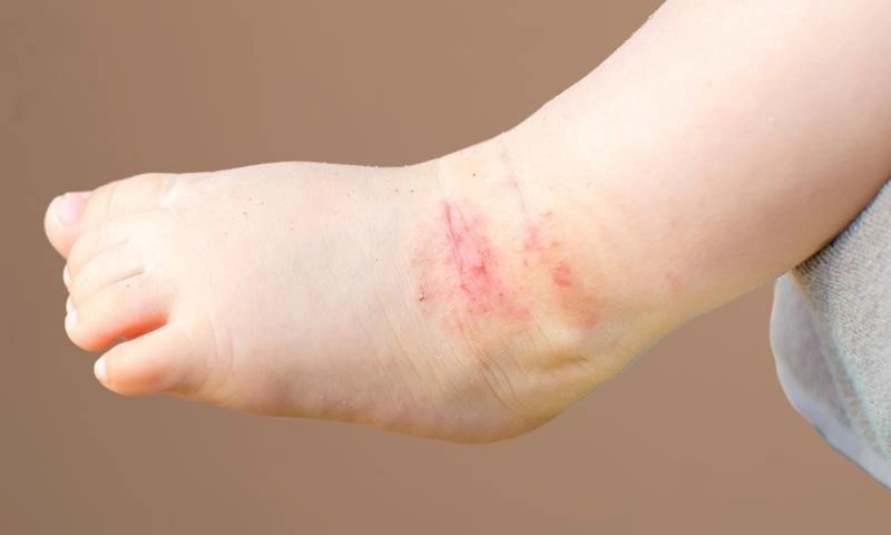 trẻ sơ sinh nổi mẫn đỏ do đâu