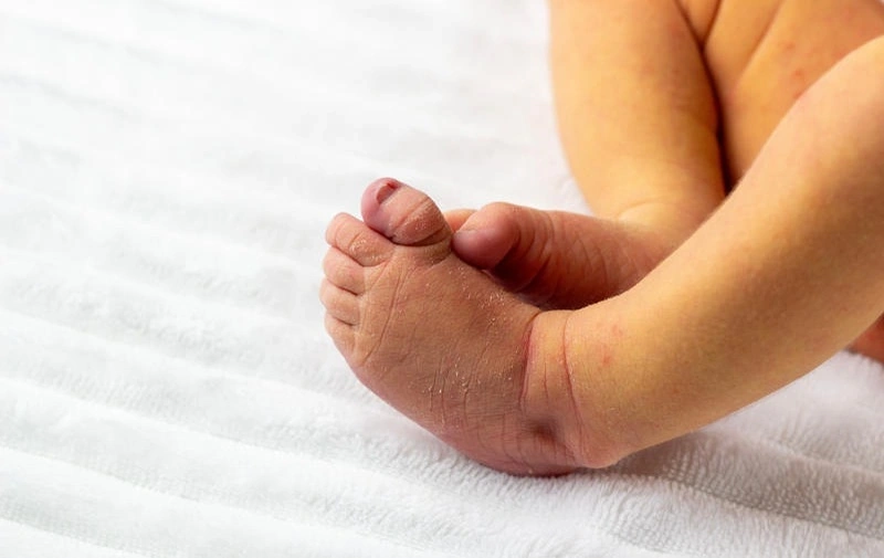 Nhận biết vàng da ở trẻ sơ sinh